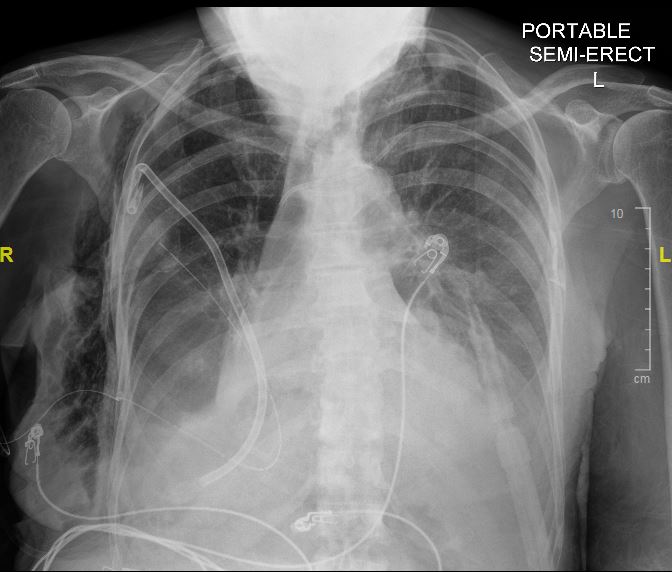 critical-cases-tension-pneumothorax-em-daily
